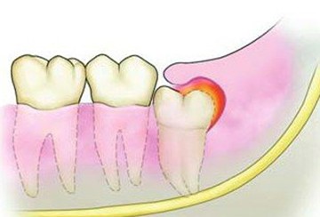 [新聞] 智齒引蜂窩性組織炎 牙根牽引術拔牙救治