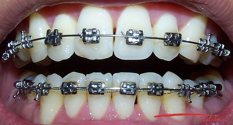 [新聞]  六名患者牙齒矯正未做完牙醫突然失聯