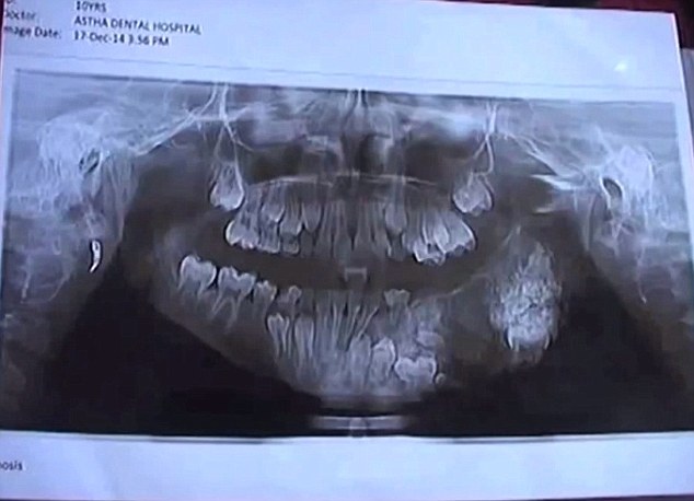[新聞]  上顎塞滿80顆牙！7歲男童罹齒瘤、口內亂牙增生