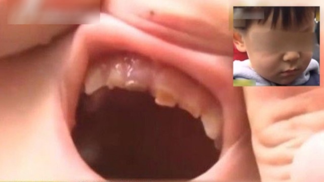 [新聞]  3歲童咬同學　被對方祖母「剪」斷牙