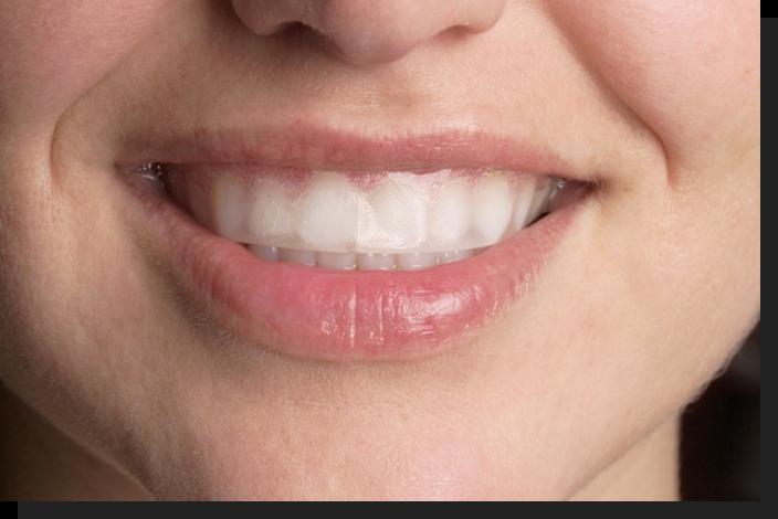 [新聞] 居家DIY牙齒美白　當心傷牙齦