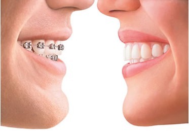 [新聞] 矯正牙齒時機如何選擇？
