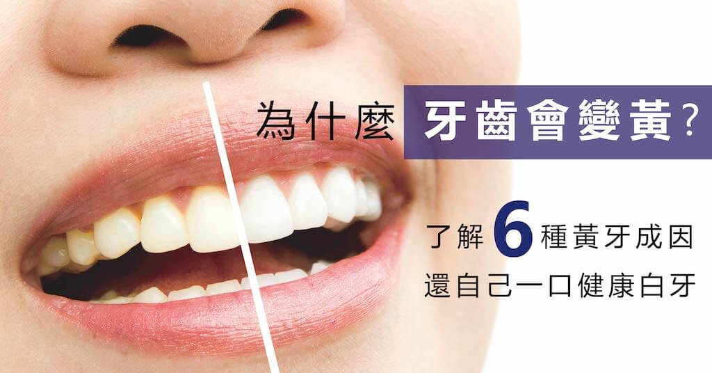 為什麼牙齒會變黃? 瞭解6種黃牙成因，再選擇健康的牙齒美白方法！