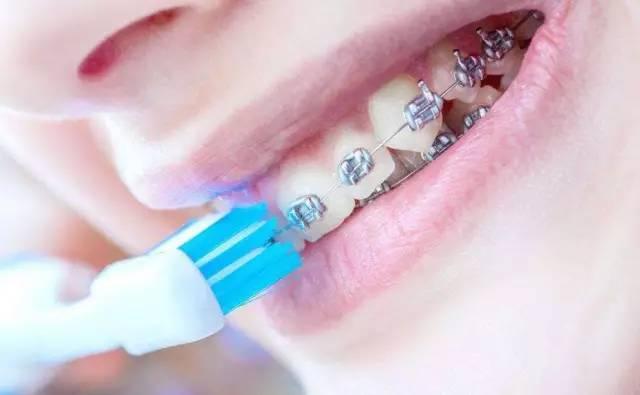 牙套黨必看！牙齒矯正期間究竟該怎麼刷牙？