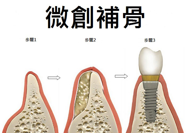 微創補骨增強植體地基 拒當植牙冤大頭