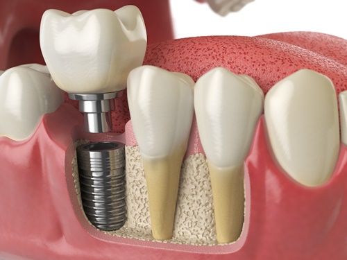 小傷口時代—微創補骨合併植牙 患者滿意度高