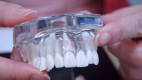選擇性激光熔化技術在可摘局部義齒支架製作的應用