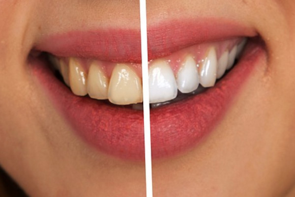 牙齒上白白的東西是牙結石前期，不注意清除後果很嚴重！