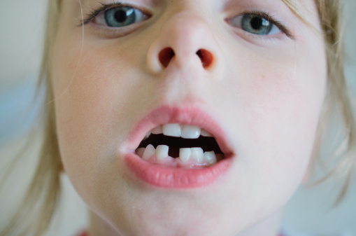 孩子換牙變暴？ 下顎骨發育不良是禍首