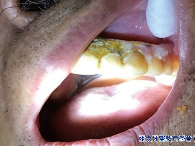 牙醫：牙膏漱口水傷假牙 恐引起口腔發炎