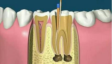 怎樣治療上火牙痛? 上火牙疼的原因?