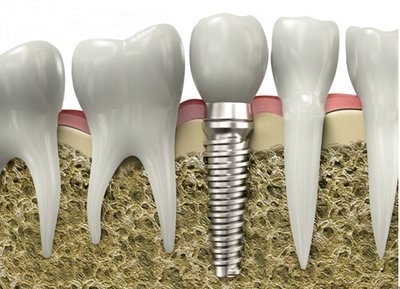 重度牙周炎患者牙槽骨條件差，還能做種植牙嗎？