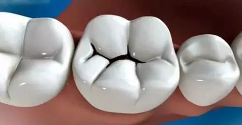 [新聞] 樹脂補牙是什麼？